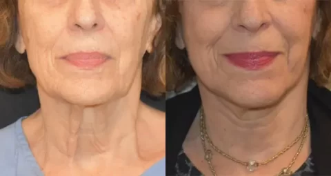 A woman's face before and after liposuction and neck lift.