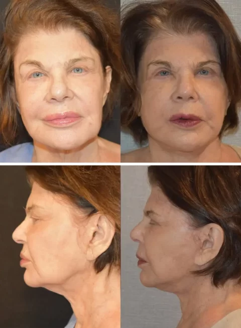A woman's face before and after liposuction and neck lift.