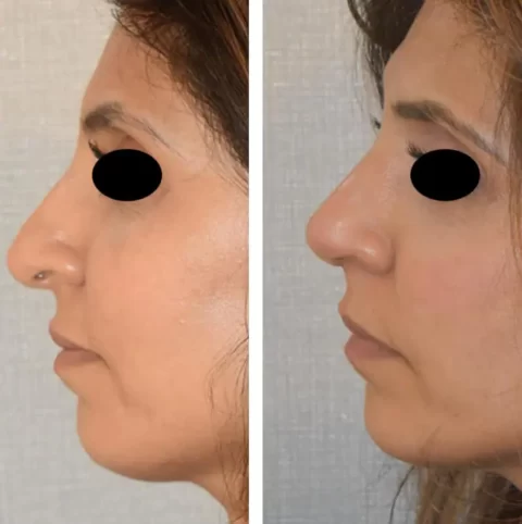 Rhinoplasty Before and After Photos - witness the transformation!