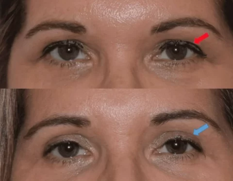 A woman's eyes undergo a transformation with blepharoplasty, as seen in before and after photos.