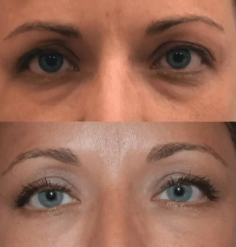 Before and after photos showcasing the effects of Blepharoplasty on a woman's eyelids.