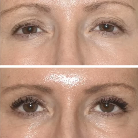 Before and after photos showcasing the transformative results of a woman's eyelashes post-blepharoplasty treatment.