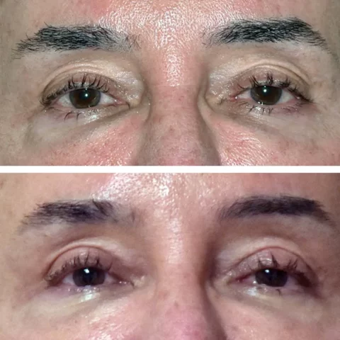 Blepharoplasty before and after photos showcasing a man's eyelids transformation
