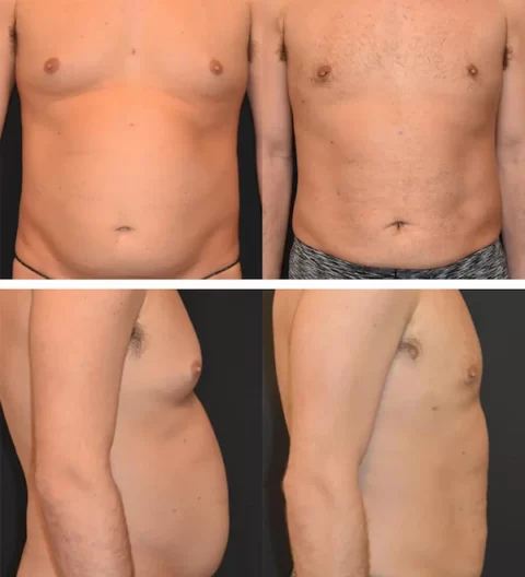 Bodytite tummy tuck before and after.