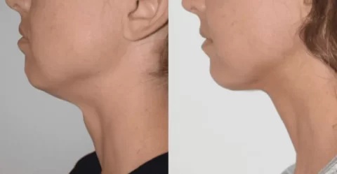 Bodytite liposuction visibly transforms a woman's neck in before and after photos.