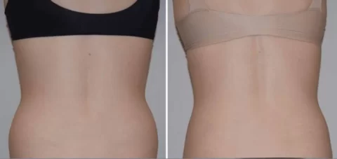 Bodytite tummy tuck before and after photos.