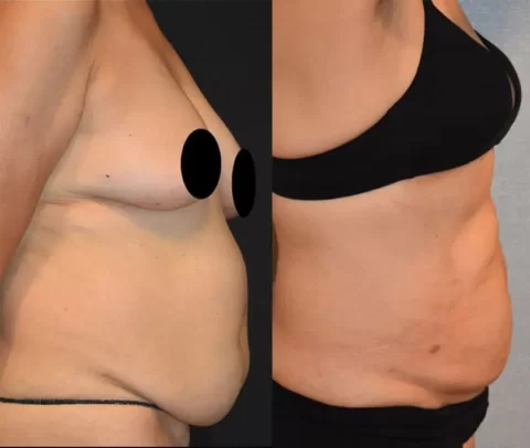 Bodytite tummy tuck before and after photos.