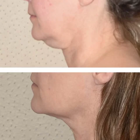 Bodytite effectively transforms the appearance of a woman's neck through liposuction, as seen in these stunning before and after photos.