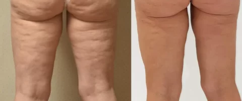 Bodytite before and after photos showcasing the transformation of a woman's legs.