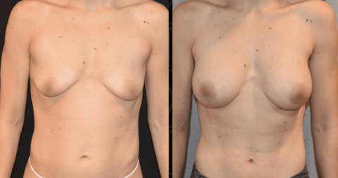 Breast Augmentation Before and After Images showcase the transformation of a woman's breasts after surgery.