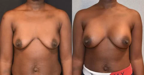 Breast Augmentation Before and After Photos.