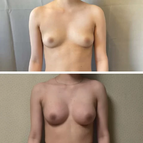 A woman's breast showcasing the remarkable transformation after undergoing breast augmentation surgery.