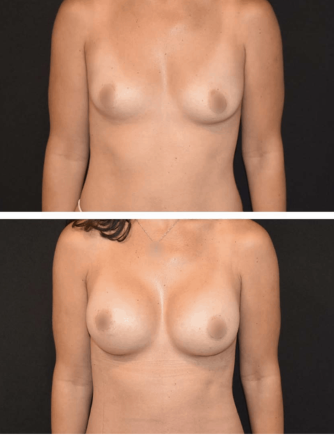 Explore stunning breast augmentation before and after images to see the transformative results.