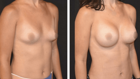 Breast Augmentation Before and After Images of a woman's breasts.