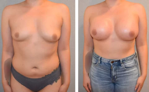 A woman's breasts transformed through breast augmentation surgery, showcasing captivating before and after images.