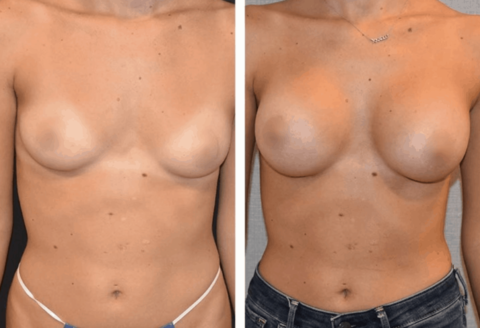 This collection showcases before and after images of a woman's breasts following breast augmentation.