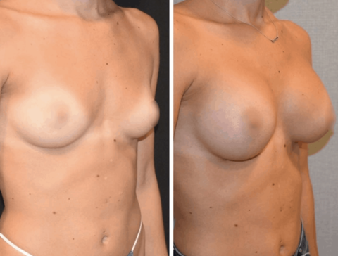 Explore breast augmentation transformations through before and after images.