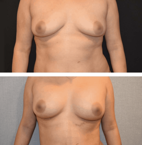 Breast Augmentation Before and After Images showcasing the transformation of a woman's breasts.