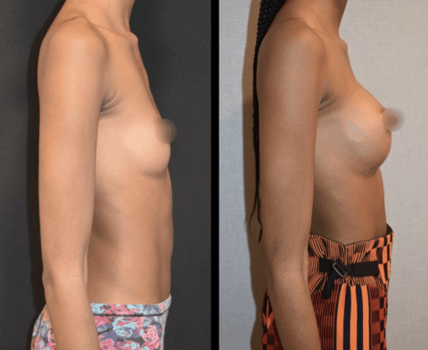 Explore stunning breast augmentation before and after images to witness the transformative results that this procedure can achieve.