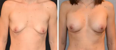 Breast Augmentation Before and After Images of a woman's breast.
