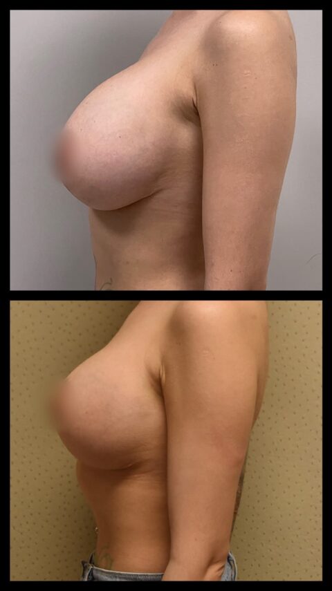 A woman's breast before and after surgery, showcasing breast implant revision with before and after photos.