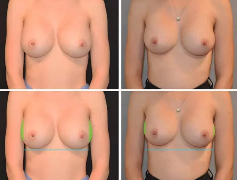 Breast Implant Revision Before and After Photos of a woman's breasts before and after breast augmentation.