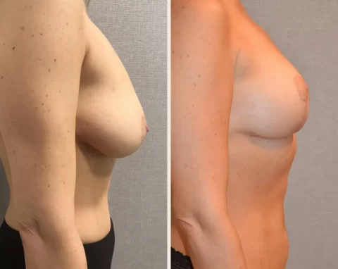 Breast Lift Before and After Photos: See the transformation of a woman's breasts after breast surgery.