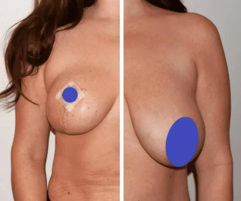 View the transformative results of a woman's breast lift surgery through breathtaking before and after photos.