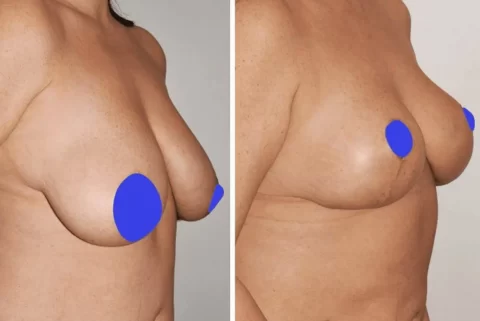 A woman's breasts before and after undergoing breast surgery, specifically a breast lift.