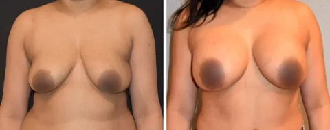 Breast Lift Before and After Photos of a woman's breasts after surgery.