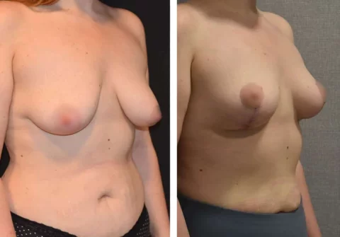 A woman's breasts before and after a breast lift surgery.