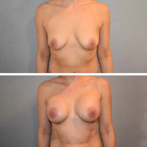 A woman's breast before and after undergoing a Breast Lift surgery.