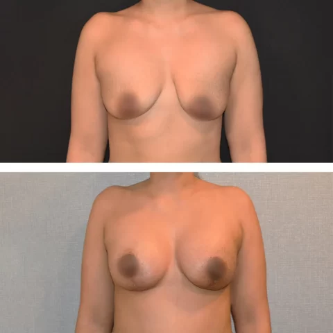 A woman's breast before and after breast lift surgery.