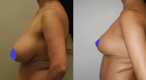 Description: A woman's breasts before and after undergoing breast reduction surgery.
