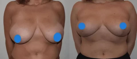 View before and after photos of a woman's breast following breast reduction surgery.