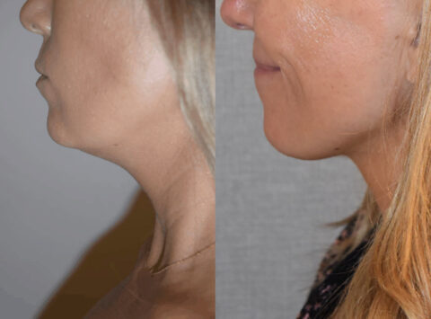 Chin liposuction can dramatically transform a woman's neck, as seen in these before and after photos.