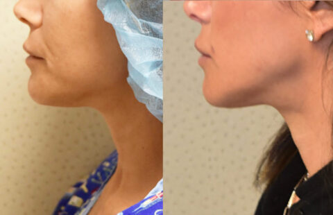 A woman's neck before and after chin liposuction.