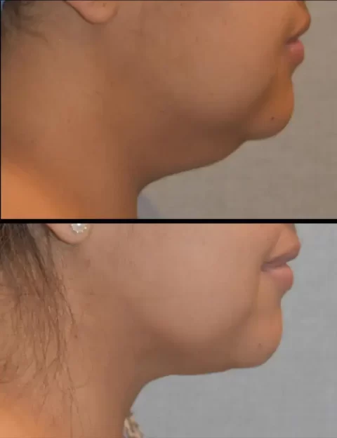A woman's neck showing remarkable transformation after chin liposuction.