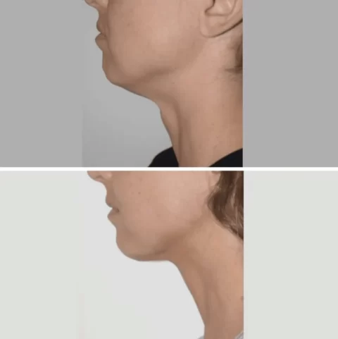 View the transformative changes of a woman's neck, from flabby to refined, through before and after photos of chin liposuction.