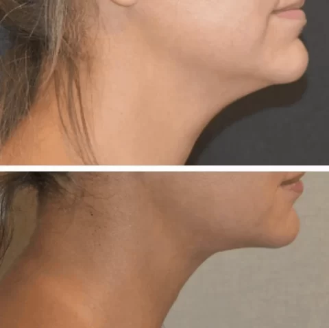 Explore the transformative results of chin liposuction through before and after photos showcasing the enhanced appearance of a woman's neck.