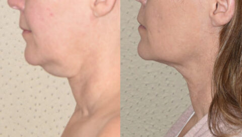 A woman's chin before and after tummy tuck.