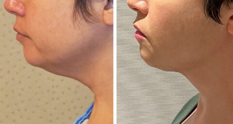 Tummy tuck and chin liposuction before and after.