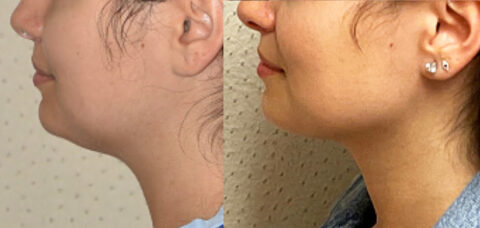 Before and after pictures of a woman's chin and neck showcasing the transformative results of chin liposuction.