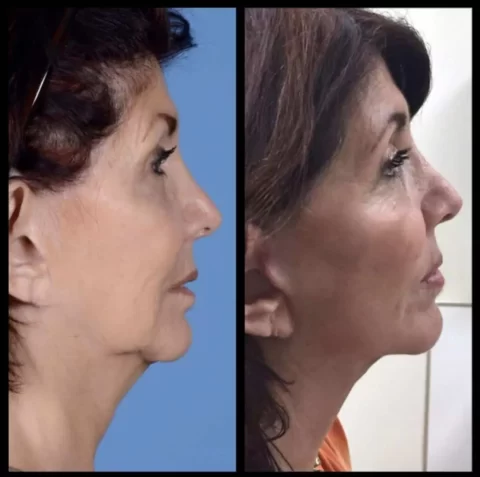 A woman's face before and after rhinoplasty, showcasing the transformative results in before and after photos.