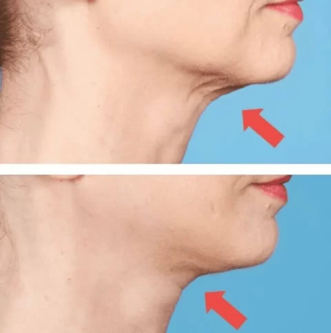 A woman's neck before and after liposuction and facelift.