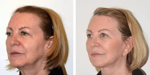 A woman's face showcasing the transformative effects of a facelift through before and after photos.