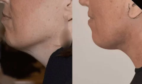 Facelift before and after photos of a woman's neck.