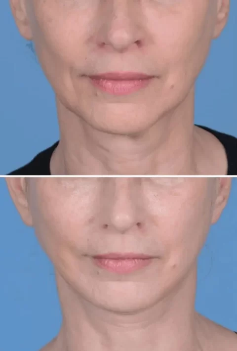A woman's face before and after undergoing liposuction and facelift procedures.