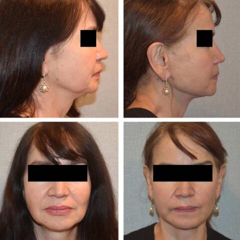 Facelift Before and After Photos of a woman's face before and after liposuction.