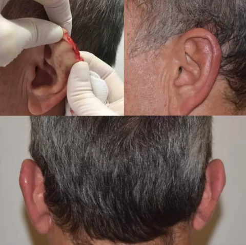 Explore our Facial Trauma and Reconstruction Before and After Photo Gallery for exceptional ear piercing experiences in San Diego, California.